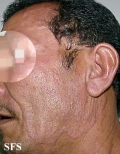 tinea facei