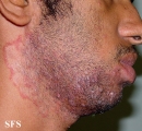 tinea facei