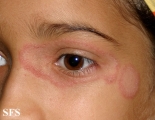 tinea facei