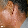 tinea facei