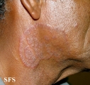 tinea facei