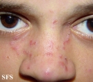 tinea facei