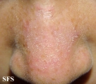 tinea facei