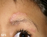 tinea facei