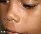 tinea facei