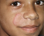 tinea facei