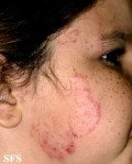 tinea facei