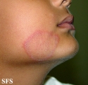tinea facei