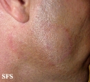 tinea facei