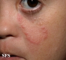 tinea facei