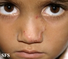 tinea facei