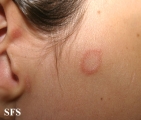 tinea facei