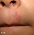 tinea facei