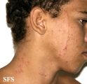 tinea facei