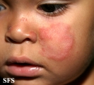 tinea facei