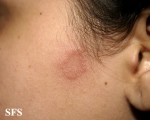 tinea facei