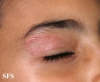 tinea facei