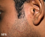 tinea facei