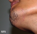 tinea facei