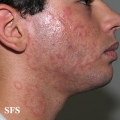 tinea facei
