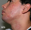 tinea facei