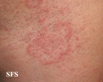 tinea facei