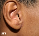tinea facei