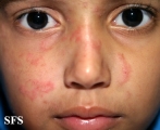 tinea facei