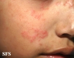 tinea facei