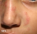 tinea facei