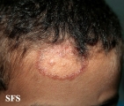 tinea facei