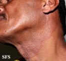 tinea facei