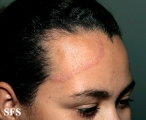 tinea facei