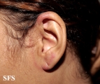 tinea facei