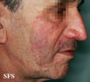 tinea facei