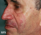 tinea facei