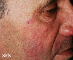 tinea facei