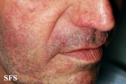 tinea facei