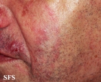 tinea facei