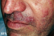 tinea facei