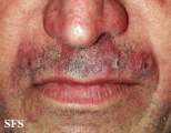 tinea facei