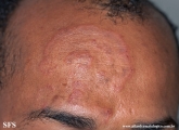 tinea facei