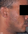 tinea facei