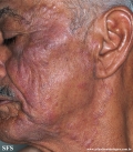 tinea facei