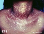 epidermodysplasia verruciformis