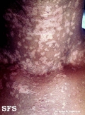 epidermodysplasia verruciformis