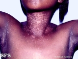 epidermodysplasia verruciformis