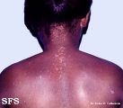epidermodysplasia verruciformis
