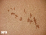 naevus epidermal