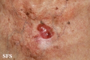 merkel cell tumours
